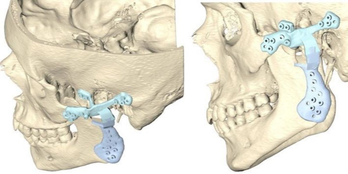 la-reconstruccion-de-la-articulacion-temporomandibular-por-un-tumor-requiere-disenar-una-protesis-a-medida