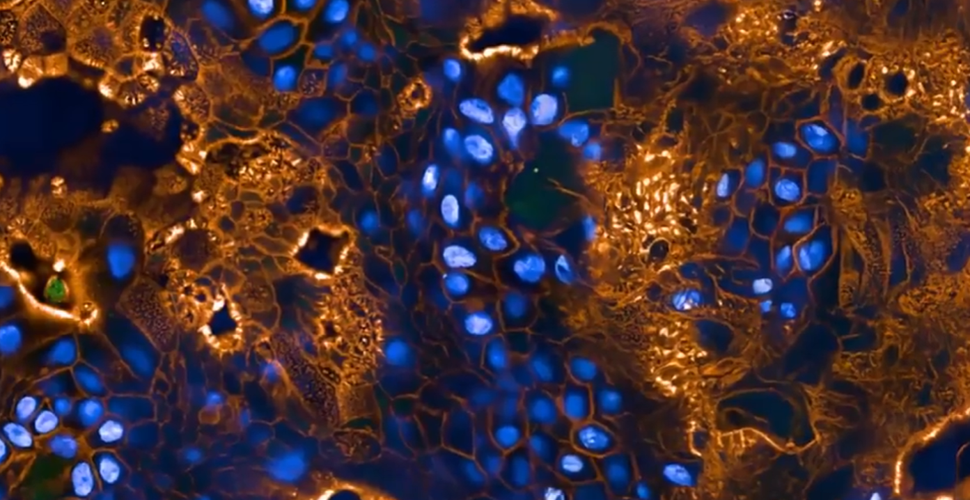 investigadores-en-sevilla-logran-resultados-prometedores-con-una-nueva-inmunoterapia-para-un-cancer-de-pulmon-agresivo-y-dificil-de-tratar