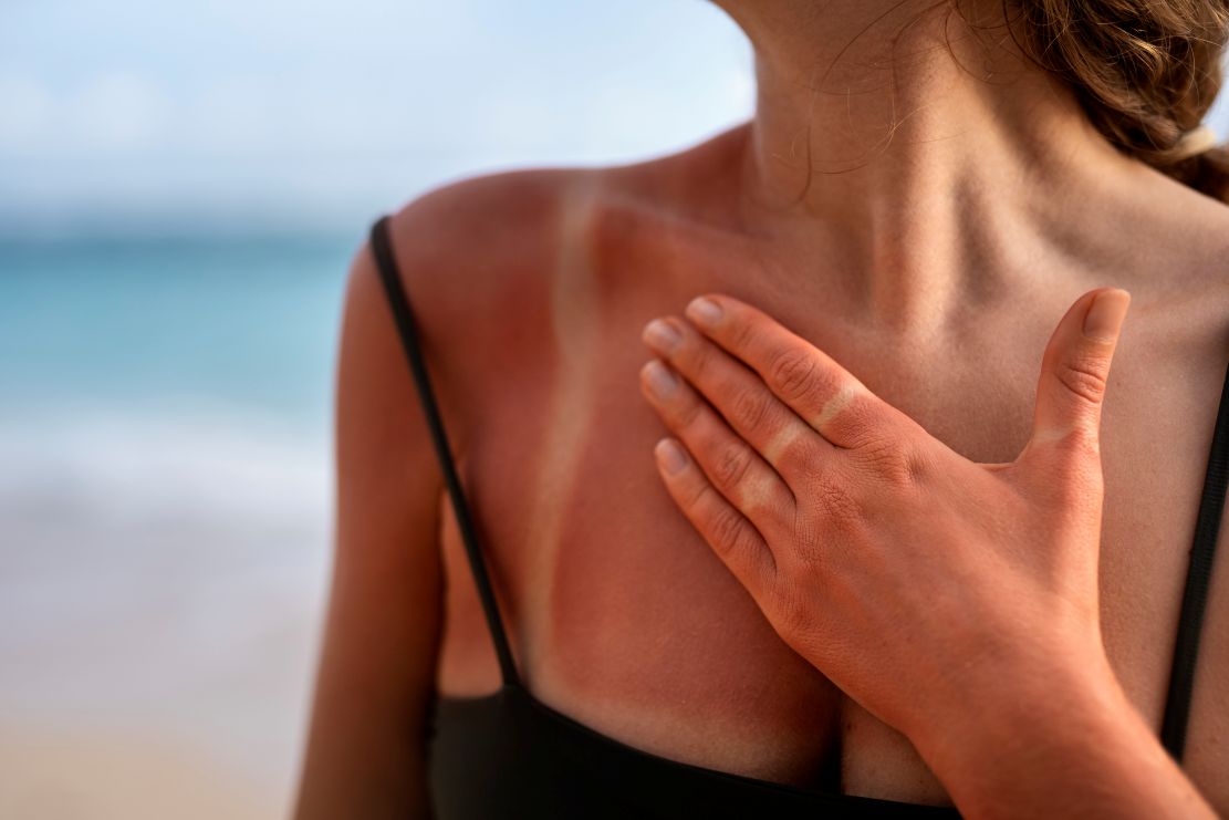 enfermedades-mas-comunes-en-verano-cuales-son-y-como-prevenirlas