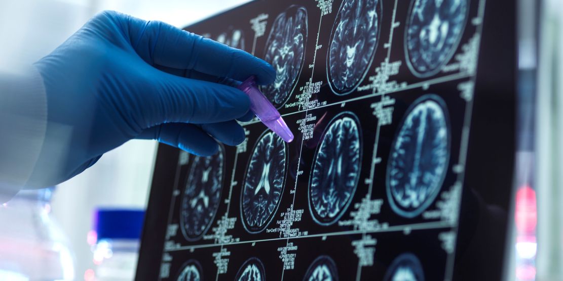 cientificos-del-csic-participan-en-la-obtencion-de-la-escala-de-riesgo-genetico-de-alzheimer-mas-completa