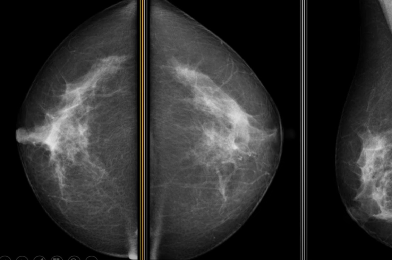 retrasos-en-cribado-de-cancer-de-mama-dejan-en-riesgo-a-2-000-mujeres-en-andalucia